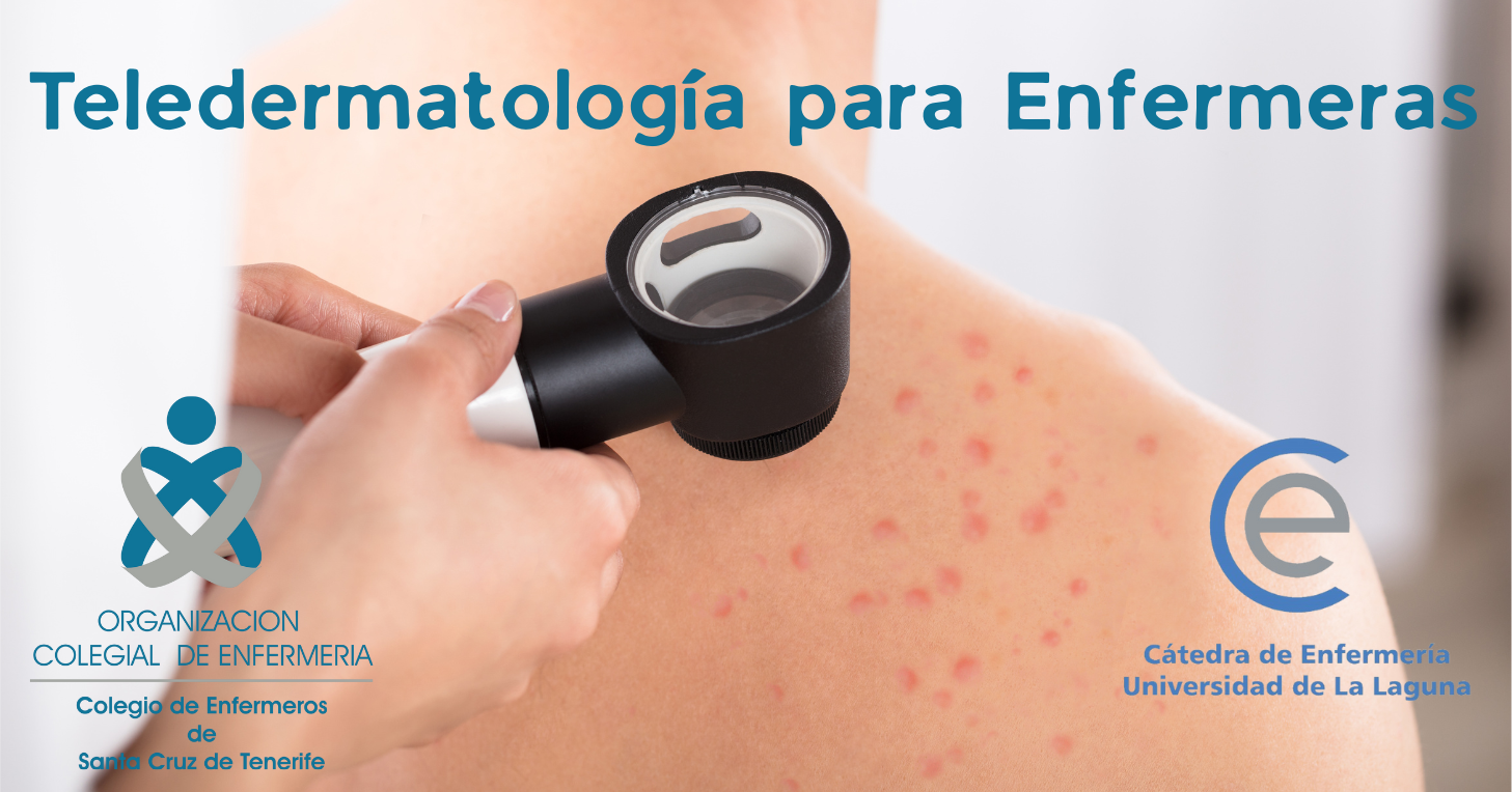 TELEDERMATOLOGÍA PARA ENFERMERAS. IMAGEN PARA EL DIAGNÓSTICO EN ATENCIÓN PRIMARIA.